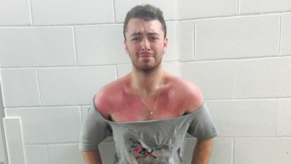 PHOTO: Sam Smith's Intense Sunburn Will Make You Cringe